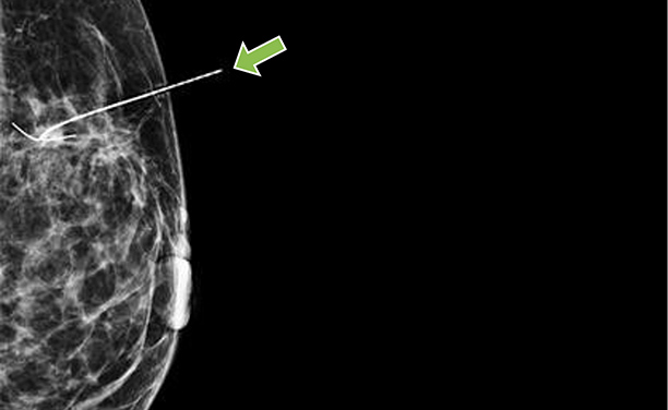 MRI of breast with wire