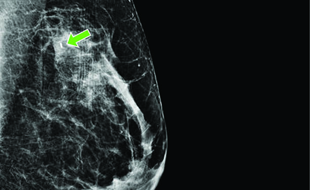 MRI of breast with seed