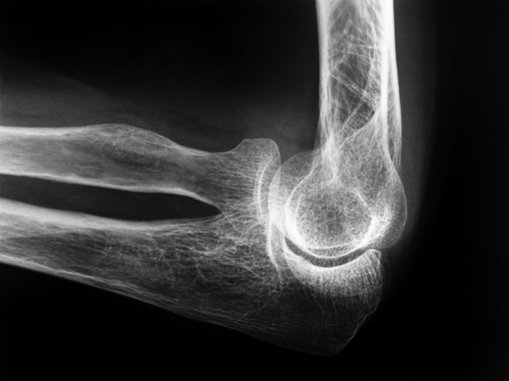 elbow xray