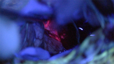 Malignant tumour viewed using 5-ALA and fluorescence microscope.
