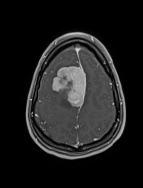 MRI of Erin’s tumour