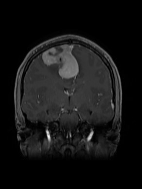 MRI of Erin’s tumour