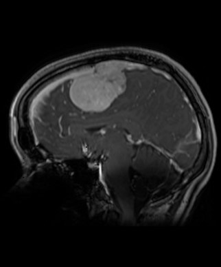 MRI of Erin’s tumour