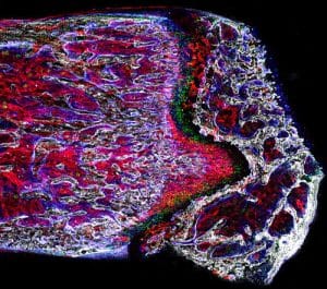 Bone research gets a break at The Ottawa Hospital
