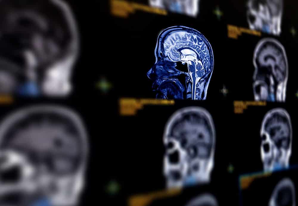 MRI brain sagittal plane for detect a variety of conditions of the brain such as cysts, tumors, bleeding, swelling, developme