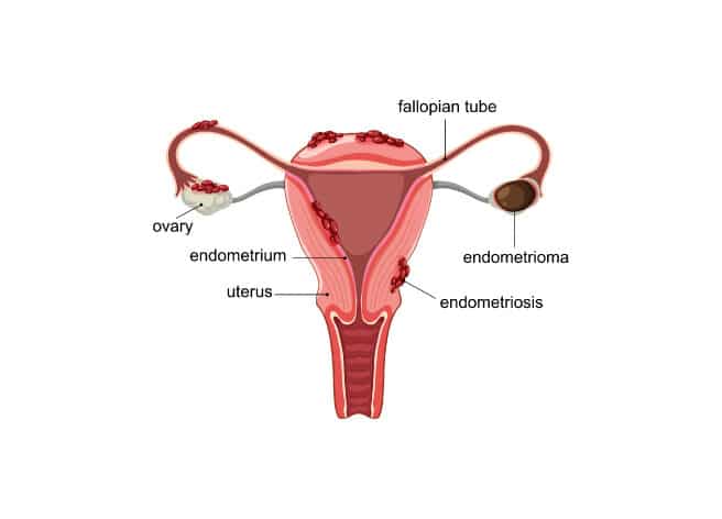 All endometriosis