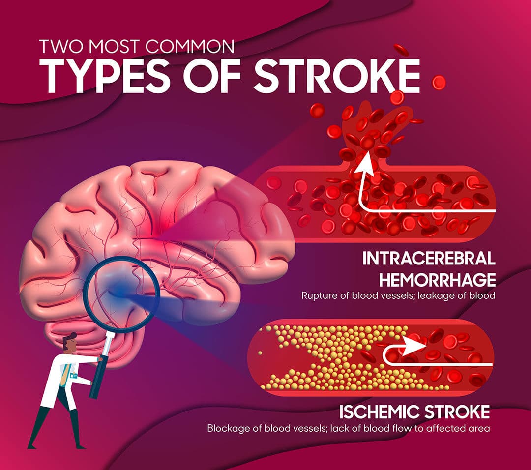 All about stroke