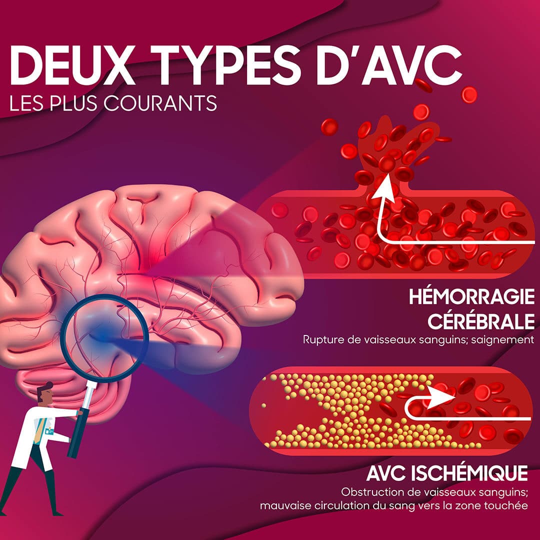 Tout savoir sur l'AVC