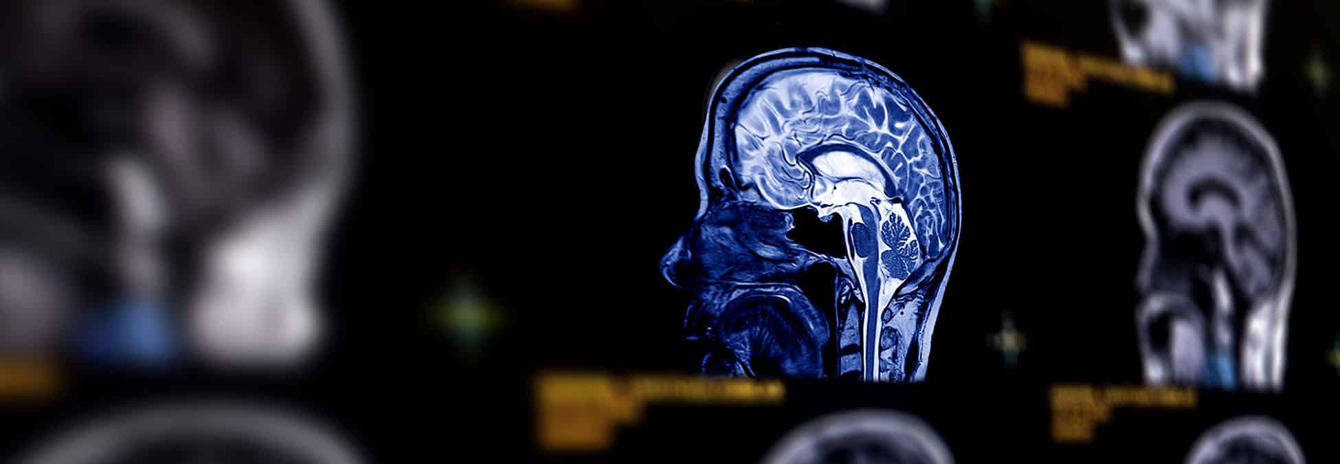MRI brain sagittal plane for detect a variety of conditions of the brain such as cysts, tumors, bleeding, swelling, developmental and structural abnormalities or infections .