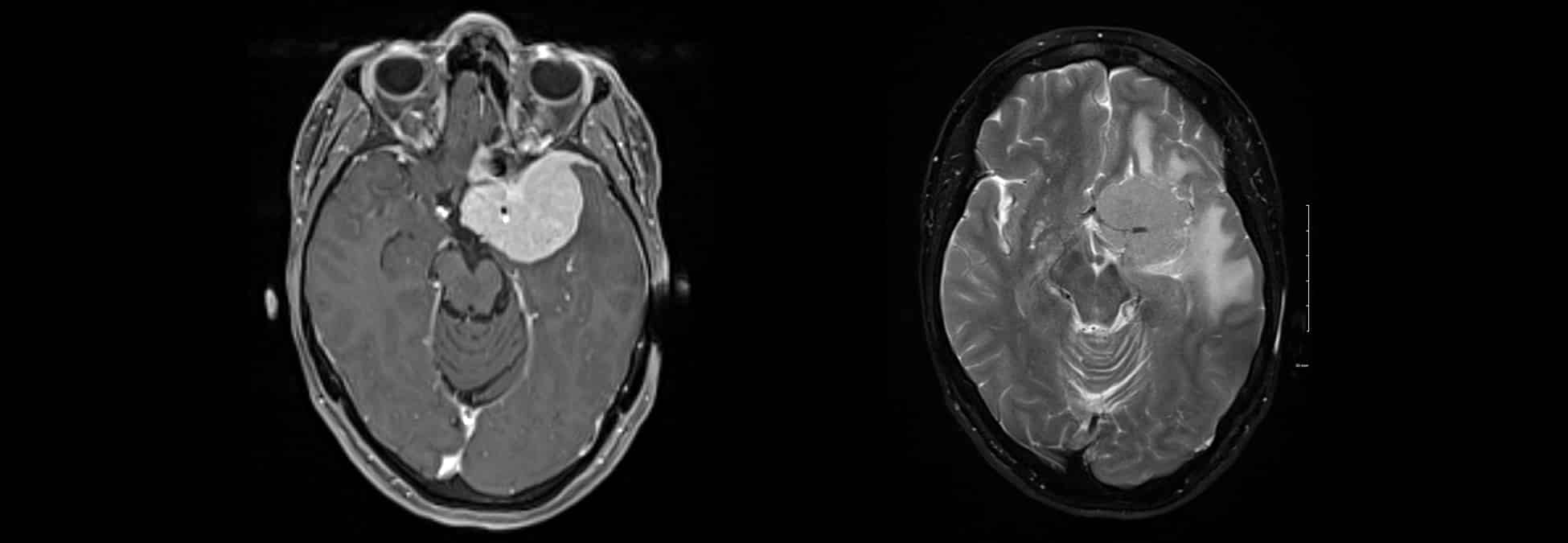 Meningioma