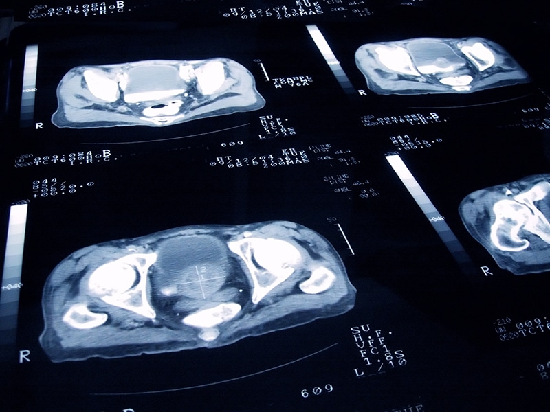 Prostate Cancer FEATURE — Dr. Michael Ong