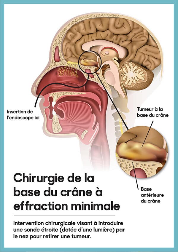 Intervention chirurgicale visant à introduire une sonde étroite (dotée d’une lumière) par le nez pour retier une tumeur.