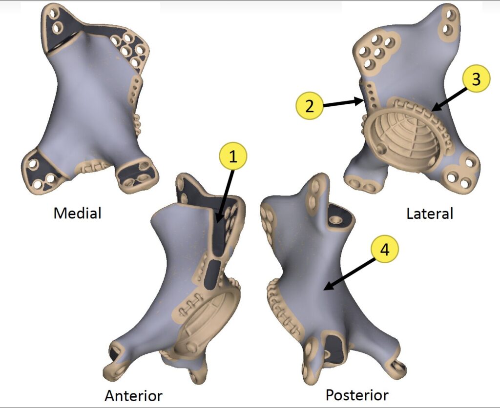 Tracy Bacenas 3D implant